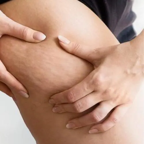 Massage anti-cellulite à Genève, La Clinique Naturelle