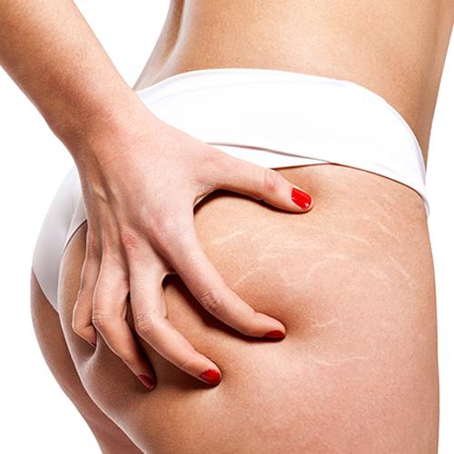 Stretch Marks Treatment - The Center for Women's Aesthetics