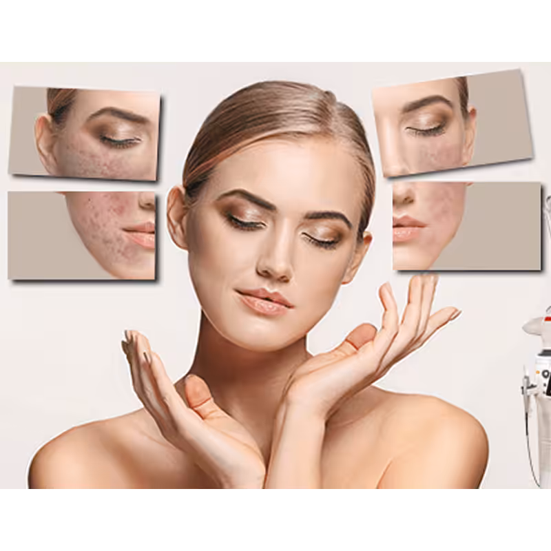 Peeling Laser Fractionné Erbium-YAG Peeling Laser Fractionné Erbium-YAG