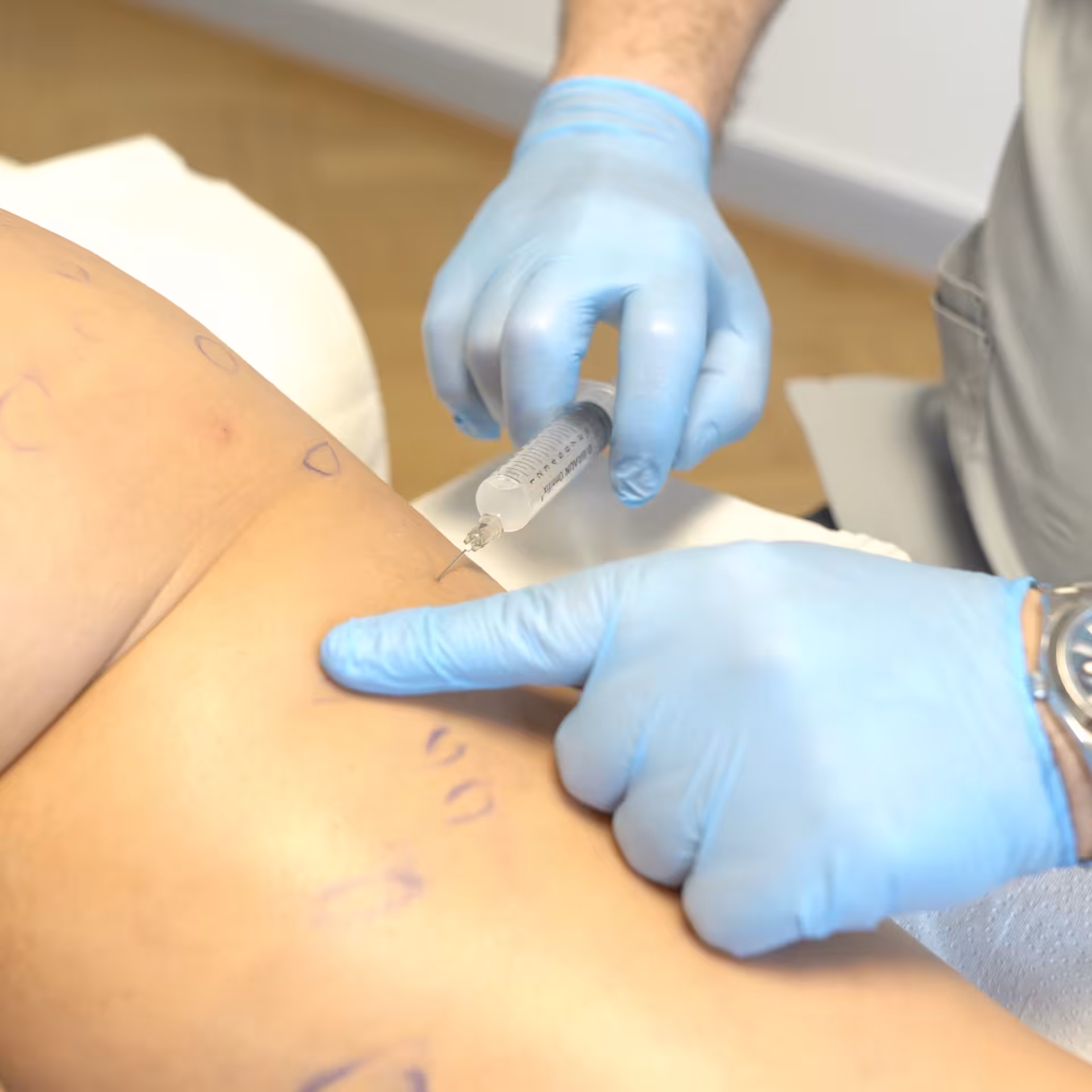 Sculptra treatment at the Aesthetic Medicine