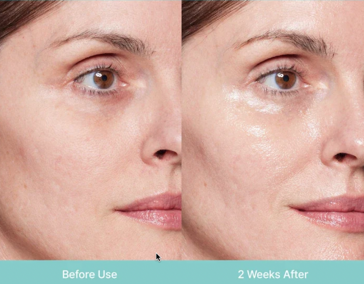 Comparaison avant et 2 semaines après du contour des yeux d'une femme, montrant l'amélioration de la texture de la peau grâce au traitement Rejuran.