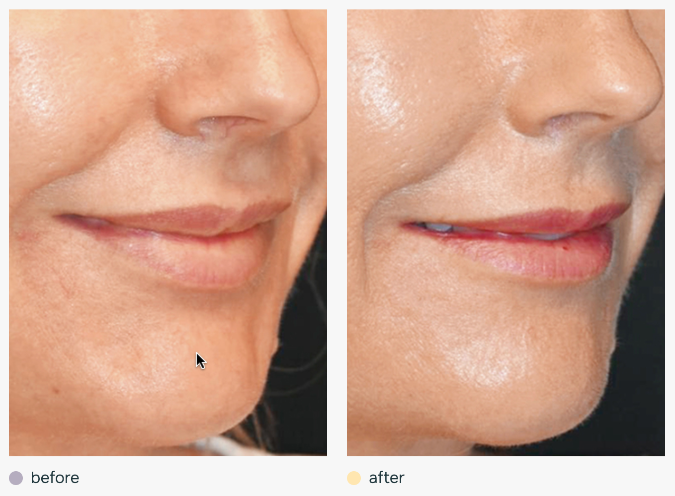 Comparaison avant et après du bas du visage et des rides du sourire d'une patiente, montrant les résultats du renouvellement cutané du traitement Julaine.
