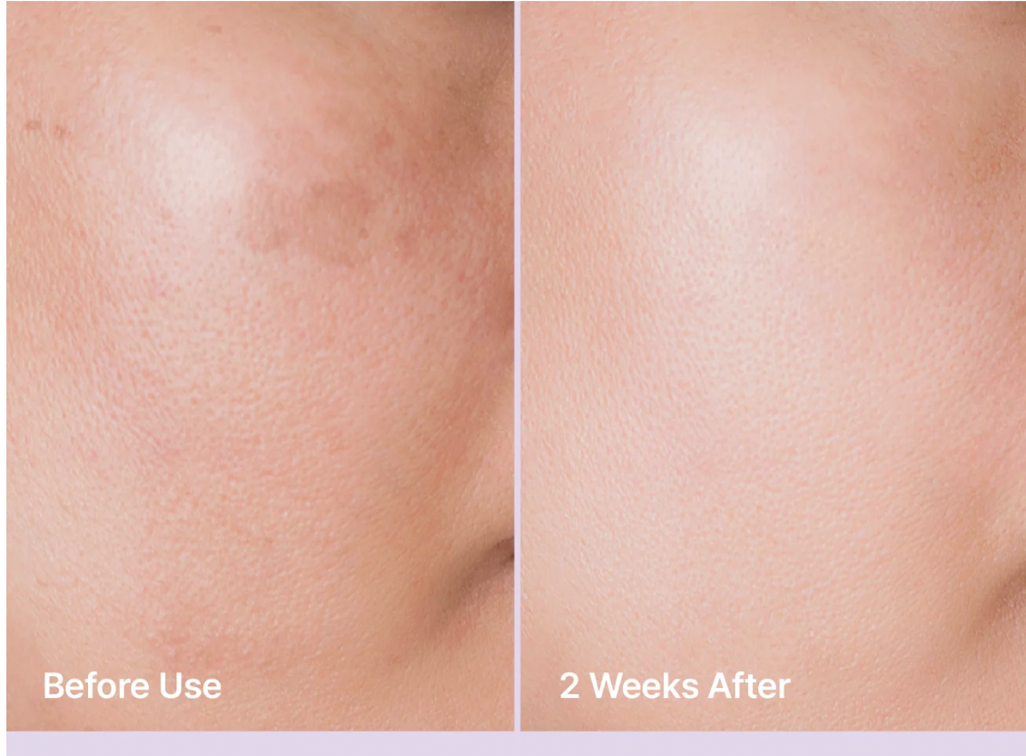 Comparaison avant et 2 semaines après montrant des rougeurs réduites et une texture de peau plus lisse sur la joue suite à un traitement Rejuran.